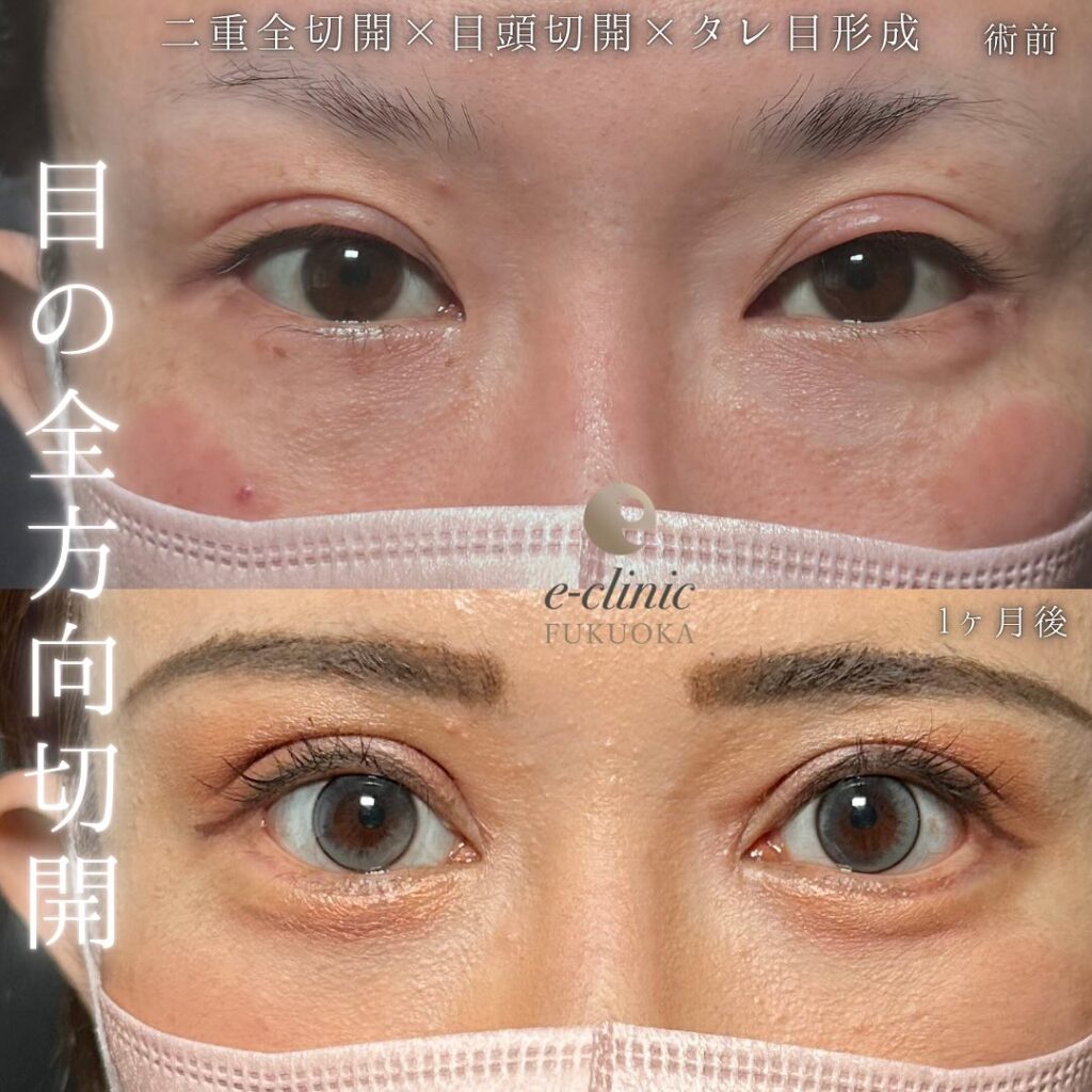 目の全方向切開の症例写真 (1)