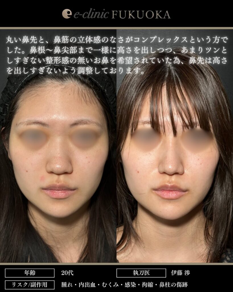 鼻尖形成と耳介軟骨移植と鼻柱下降とプロテーゼの症例写真 (4)