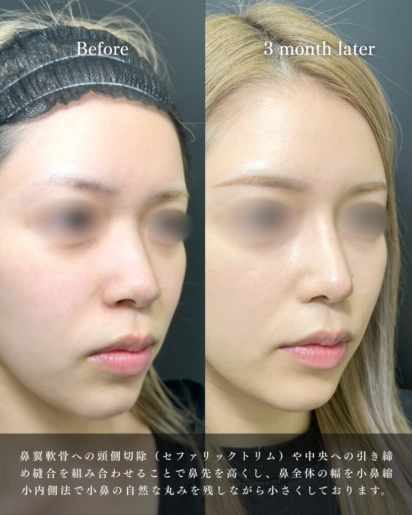 鼻尖形成と軟骨移植とプロテーゼと小鼻縮小の症例写真 (15)
