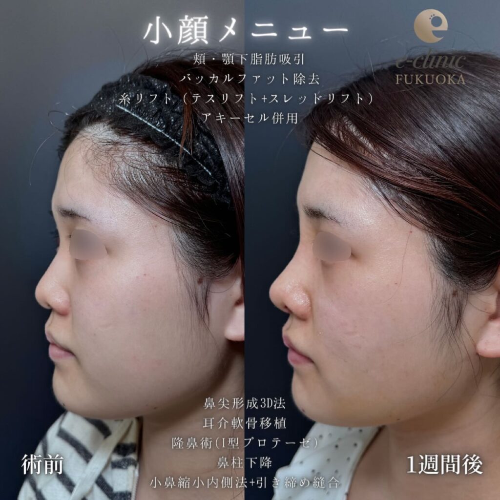 鼻尖形成と軟骨移植とプロテーゼと鼻柱下降と小鼻縮小と頬と顎下の脂肪吸引とバッカルファットと糸リフトの症例写真 (3)