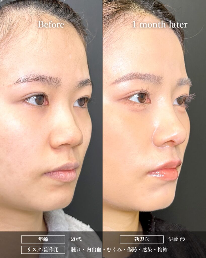 鼻中隔延長と鼻尖形成と軟骨移植と鼻柱下降とプロテーゼの症例写真 (3)