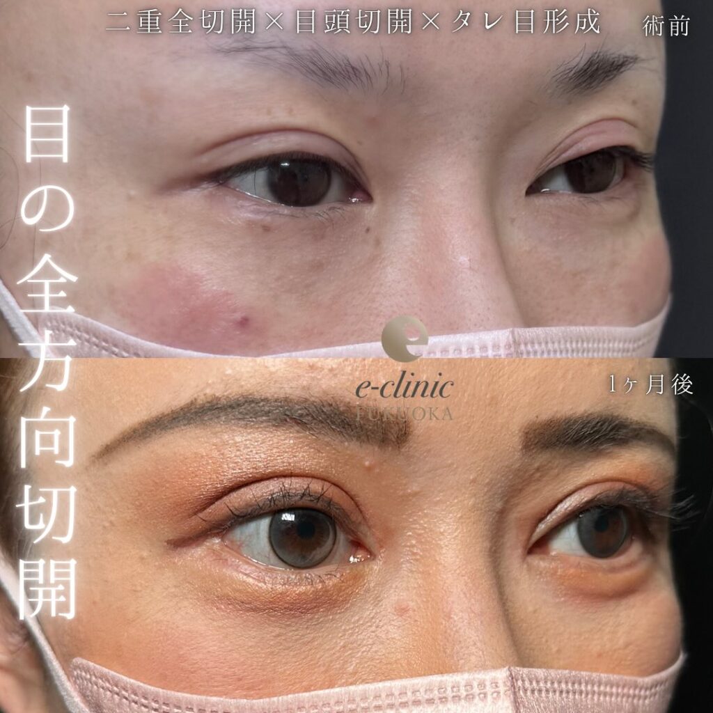 目の全方向切開の症例写真 (3)