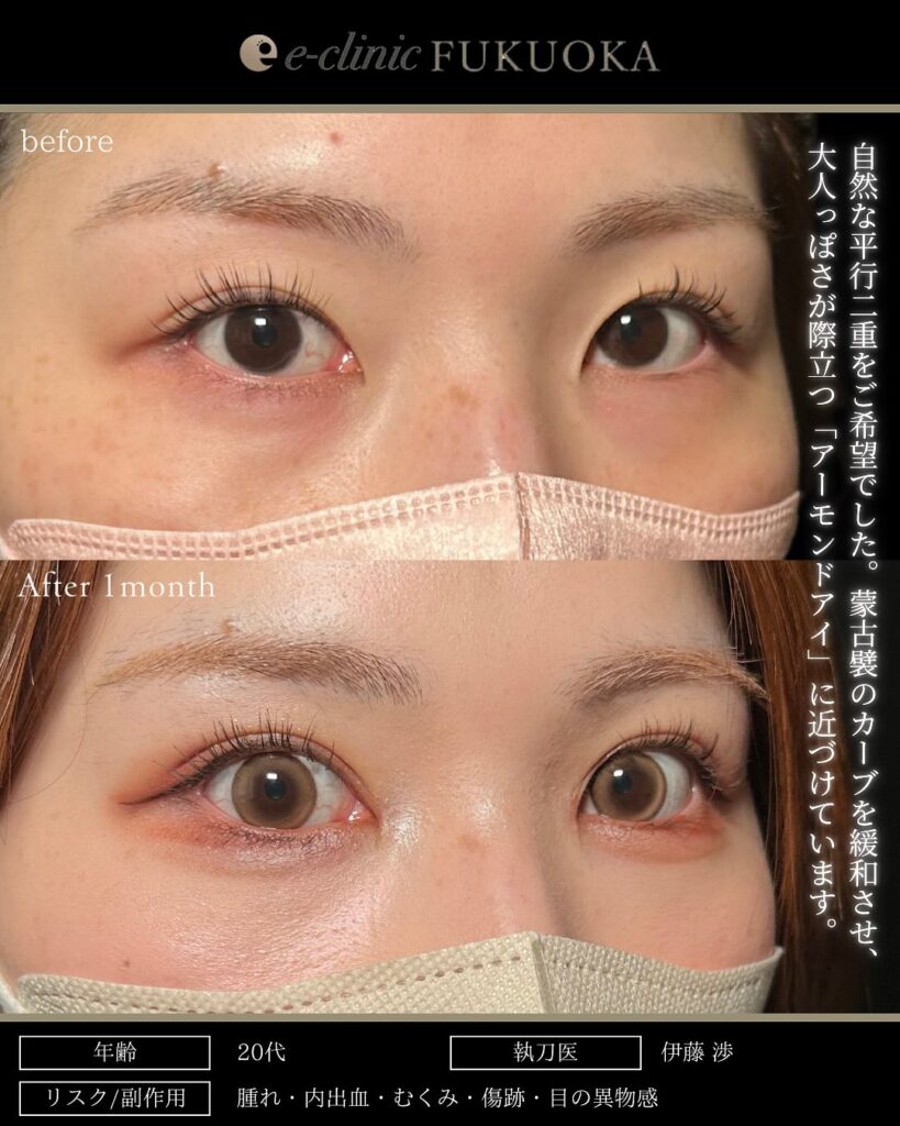 埋没法と目頭切開の症例写真 (3)