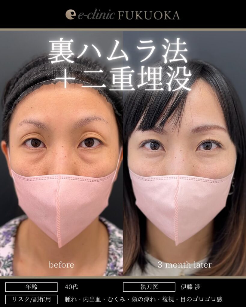 裏ハムラ法と埋没法の症例写真 (12)