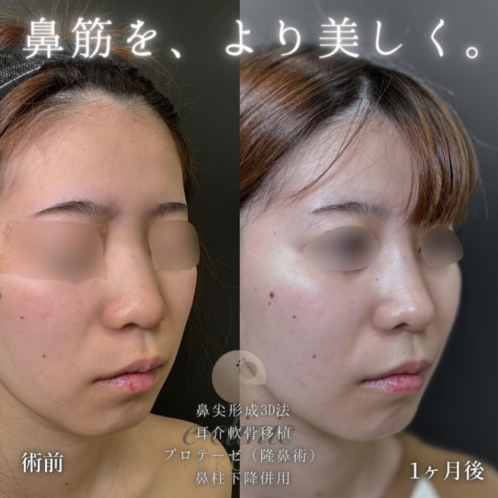 鼻尖形成と耳介軟骨移植とプロテーゼと鼻柱下降の症例写真 (3)