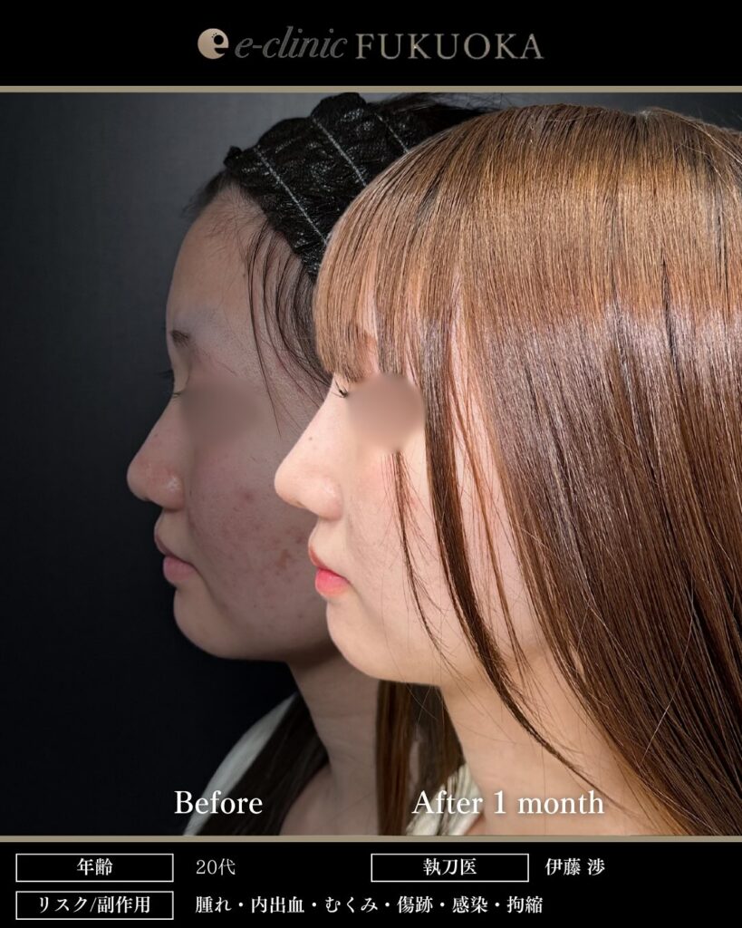 鼻尖形成と耳介軟骨移植と鼻のプロテーゼの症例写真 (3)