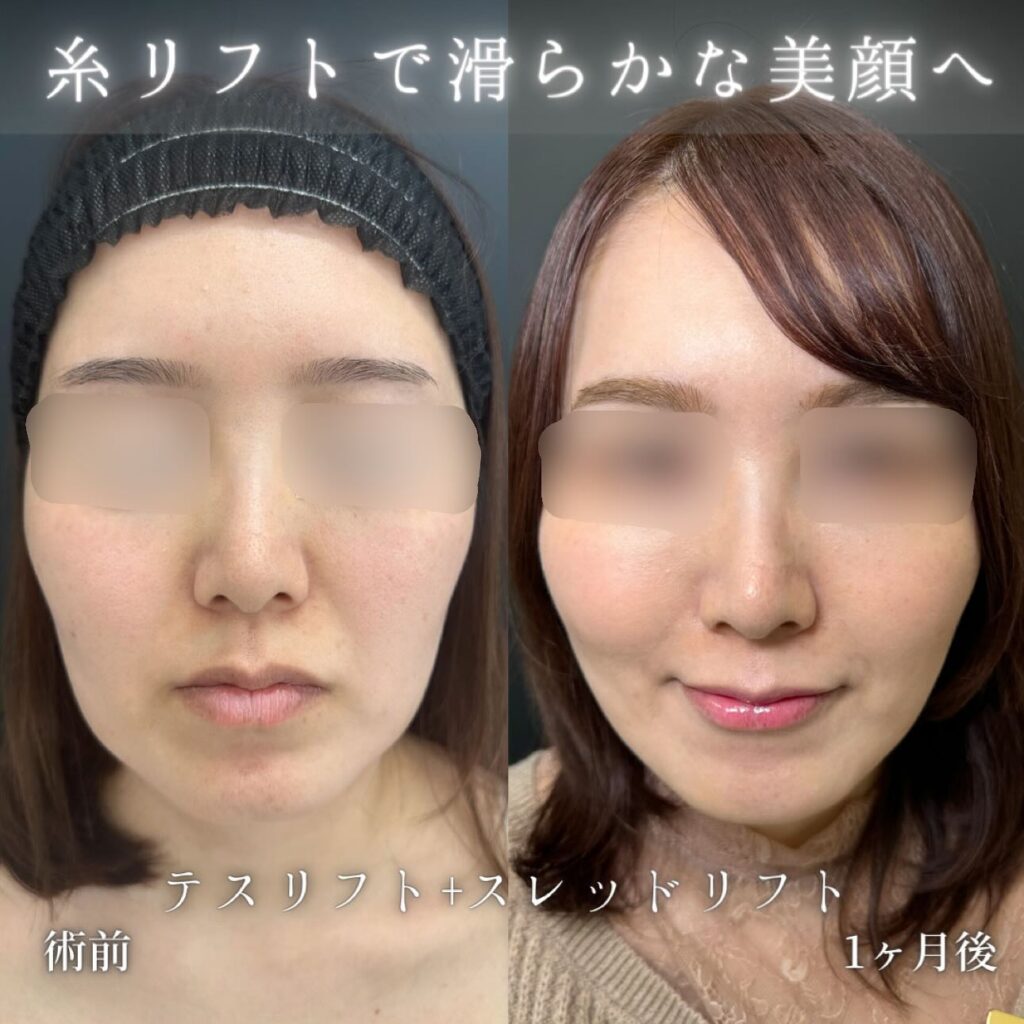 糸リフトの症例写真 (9)