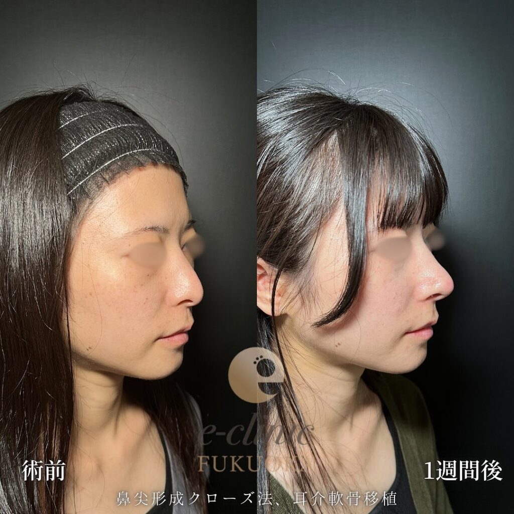 鼻尖形成と軟骨移植の症例写真 (11)