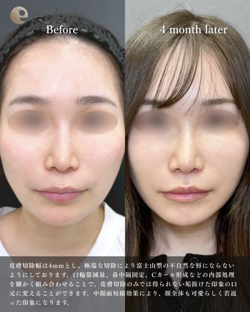 人中短縮の症例写真 (33)