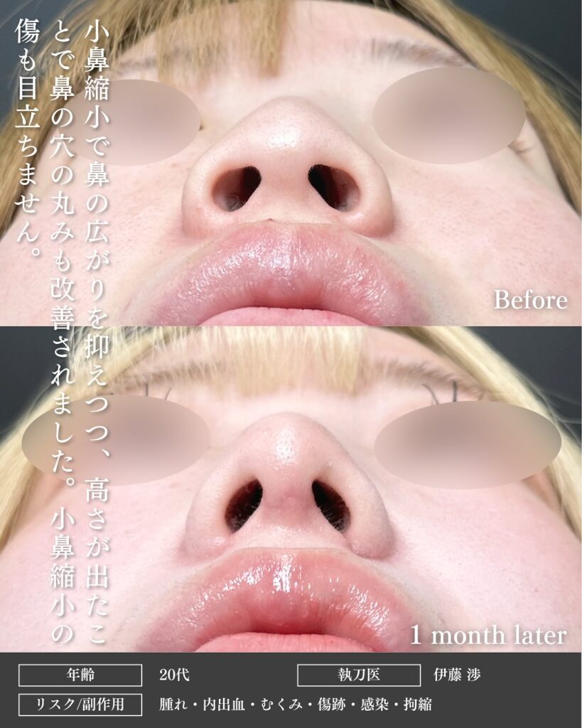 小鼻縮小と小鼻ボトックスと鼻尖形成と鼻中隔延長と軟骨移植の症例写真 (2)