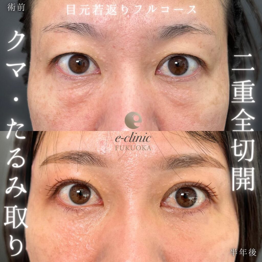 全切開と裏ハムラ法の症例写真 (1)