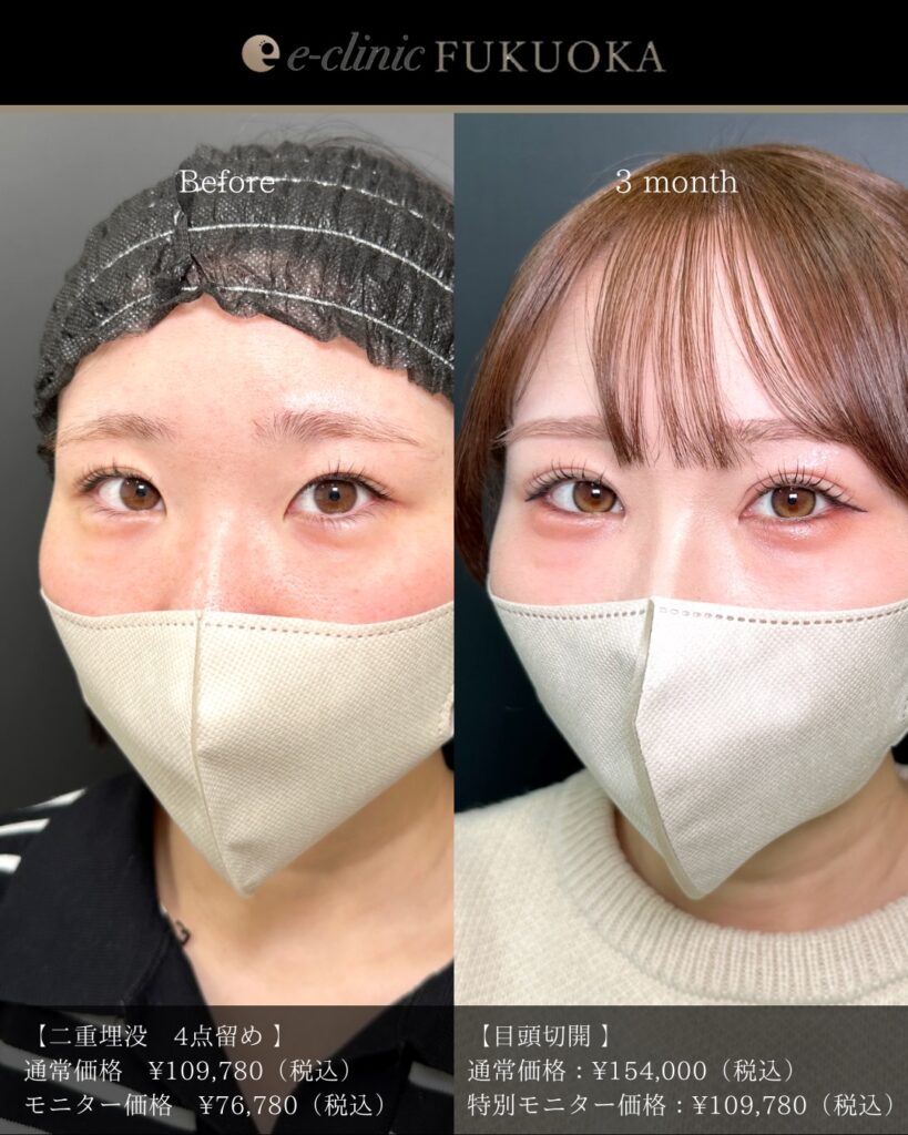 埋没法と目頭切開の症例写真 (12)