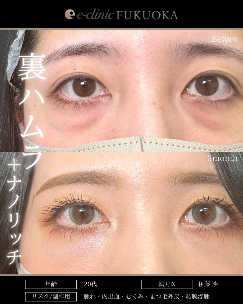 裏ハムラ法とナノリッチの症例写真 (16)