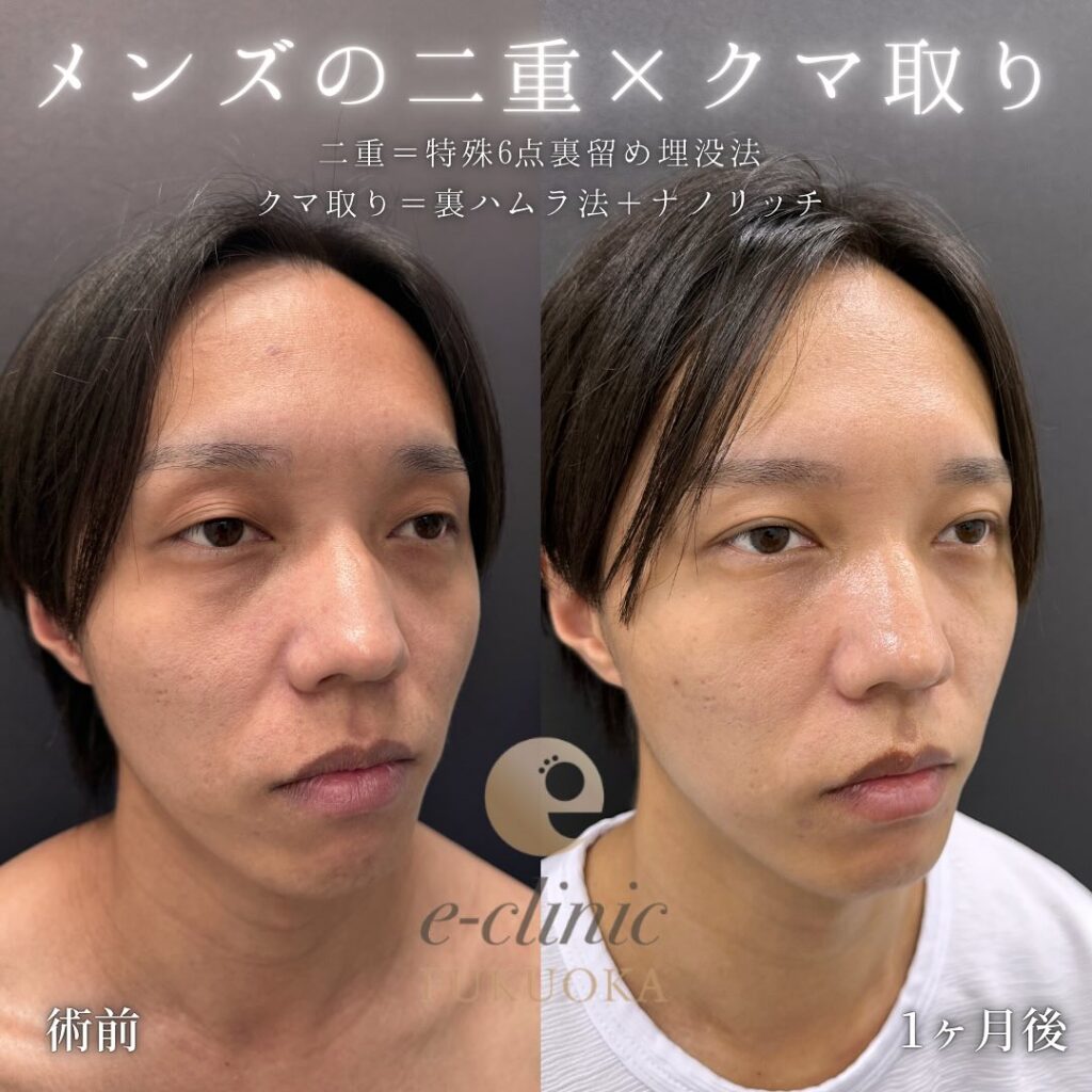 埋没法と裏ハムラ法と脂肪注入の症例写真 (2)