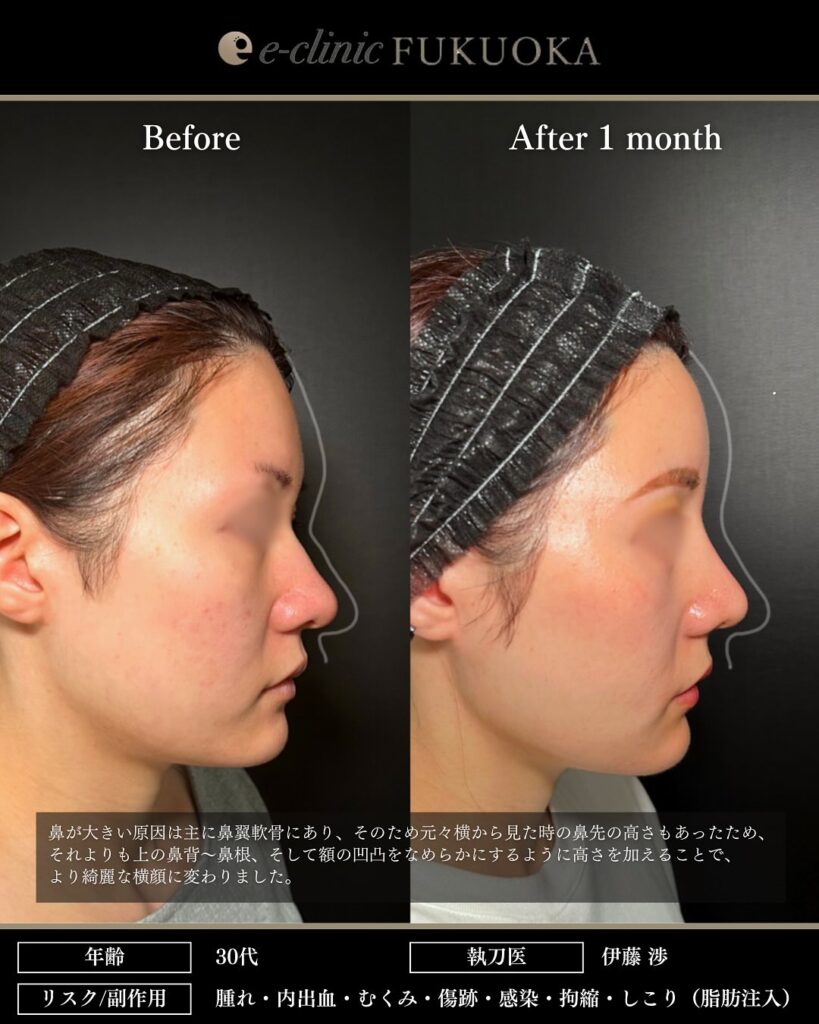 鼻尖形成と軟骨移植と小鼻縮小とプロテーゼと額とこめかみの脂肪注入と頬の脂肪吸引とジョールファットと糸リフトの症例写真 (5)