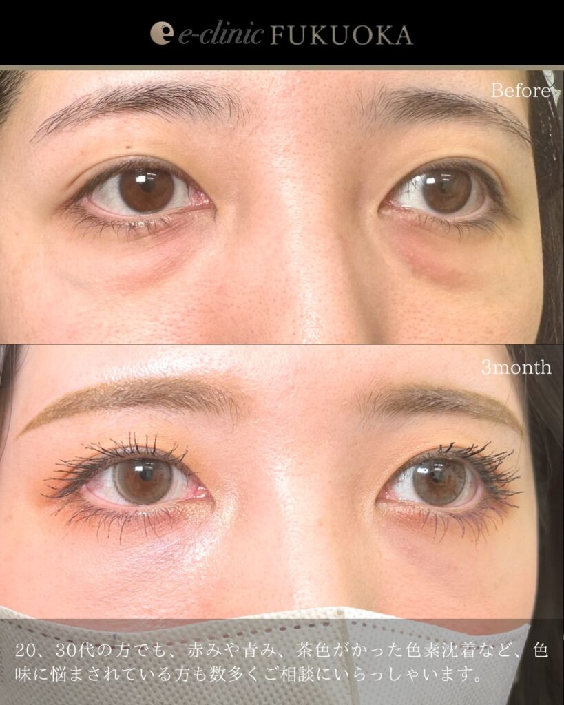 裏ハムラ法とナノリッチの症例写真 (19)