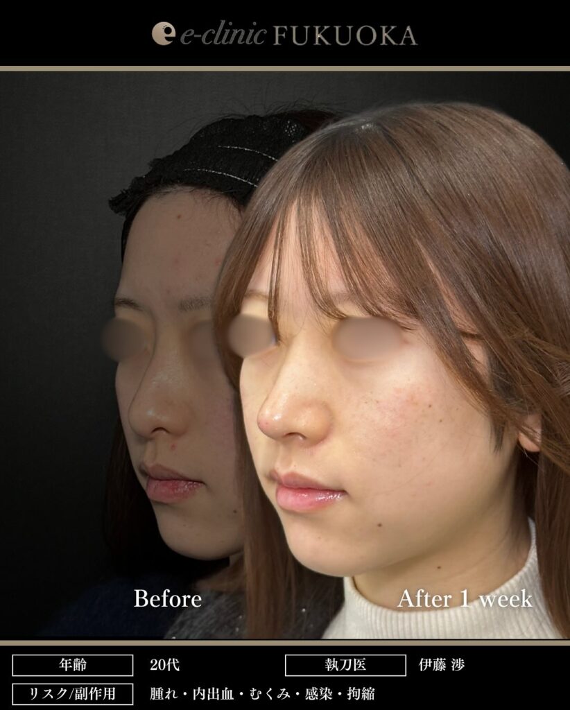 鼻尖形成と軟骨移植の症例写真 (20)