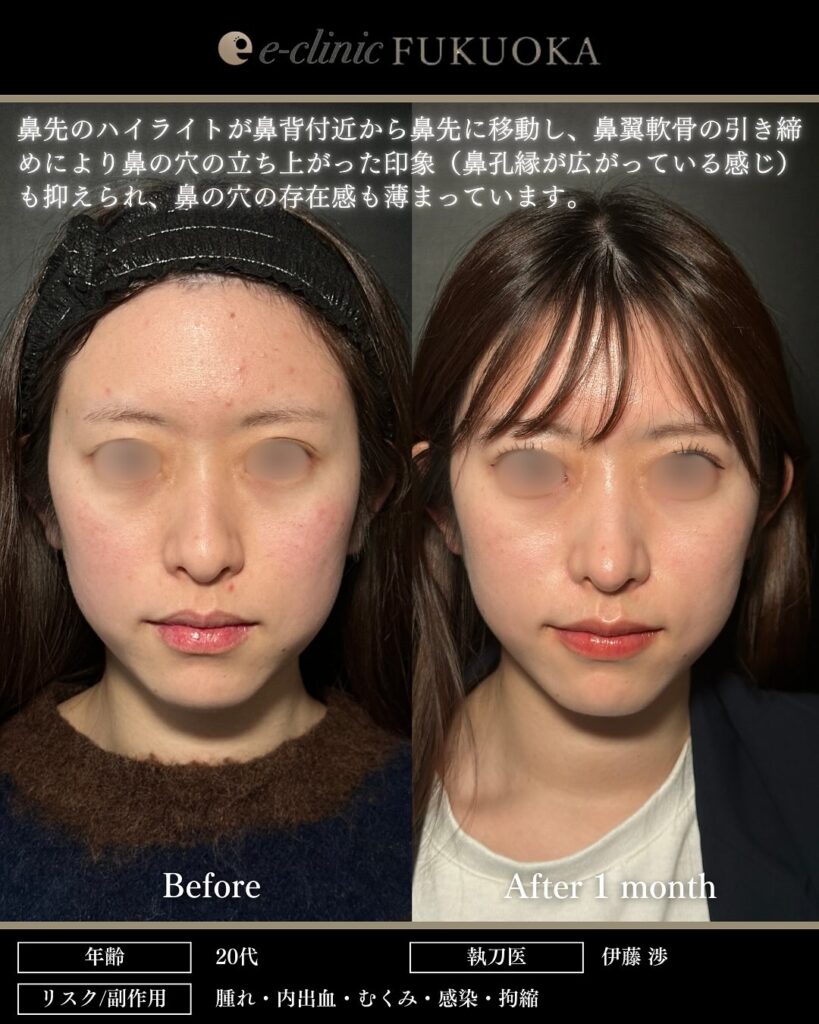 鼻尖形成と軟骨移植の症例写真 (31)