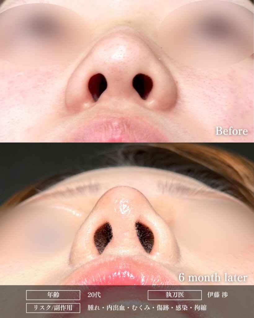 鼻尖形成と耳介軟骨移植とプロテーゼの症例写真 (6)