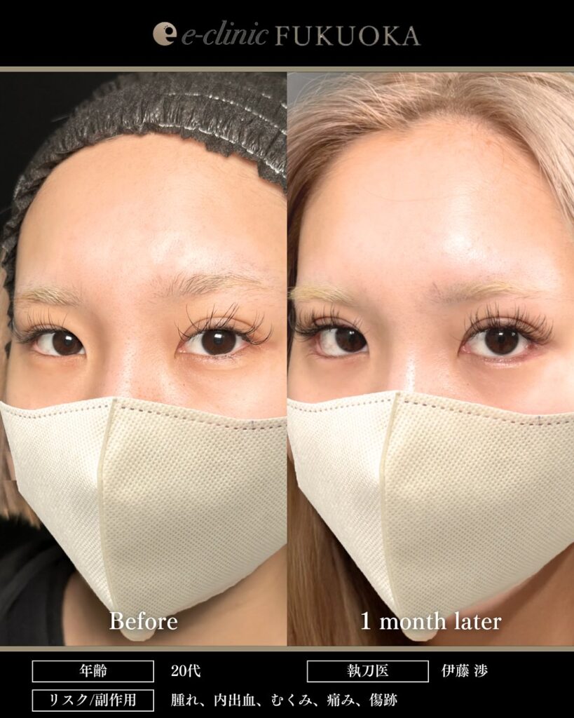 タレ目形成と目尻切開と埋没法の症例写真 (3)