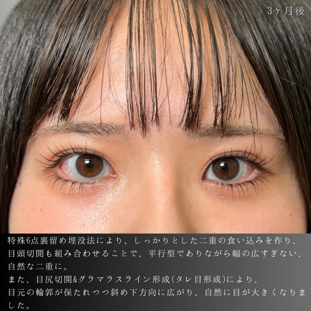 埋没法と目頭切開と目尻切開とタレ目形成の症例写真 (4)