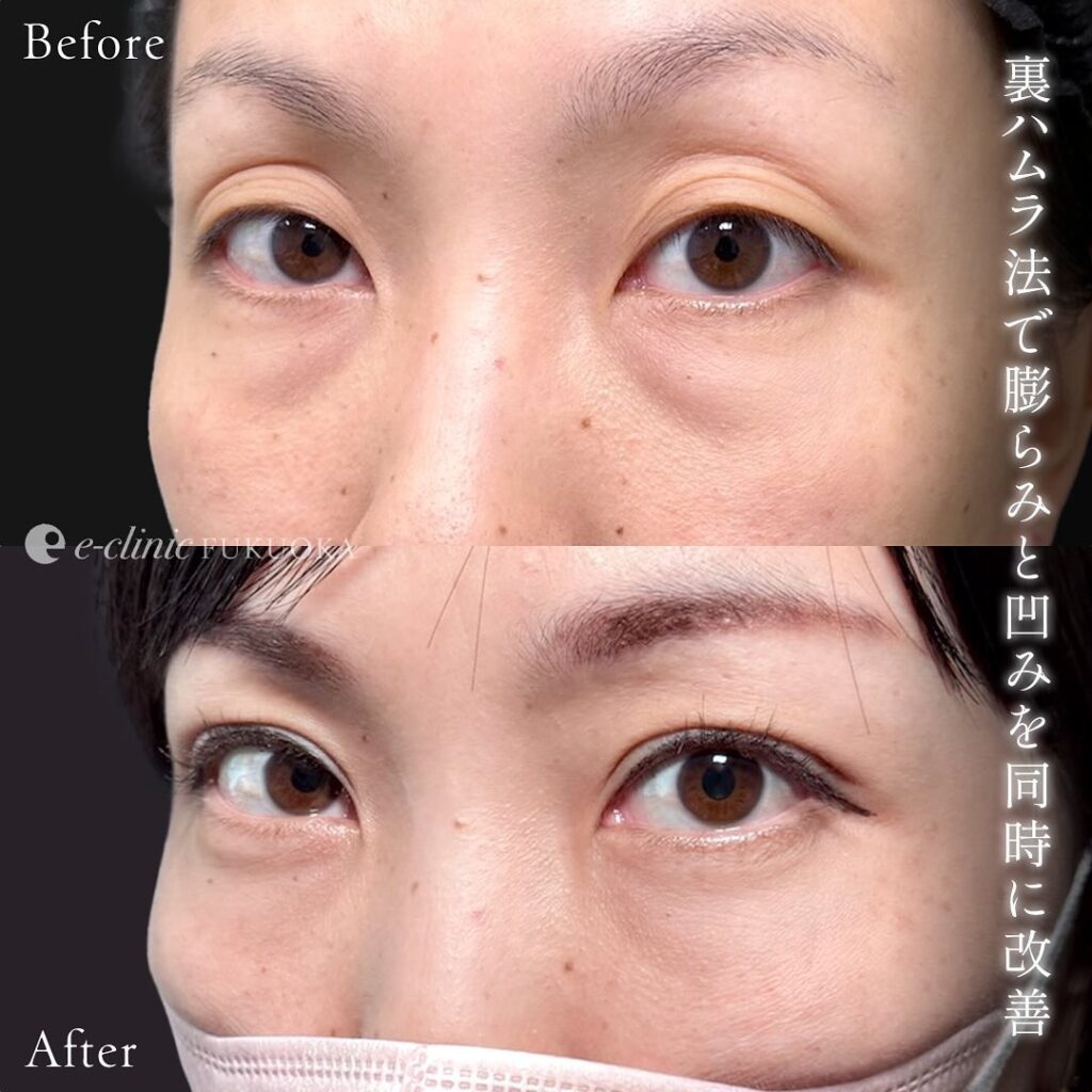 裏ハムラ法と自然癒着法の症例写真 (2)