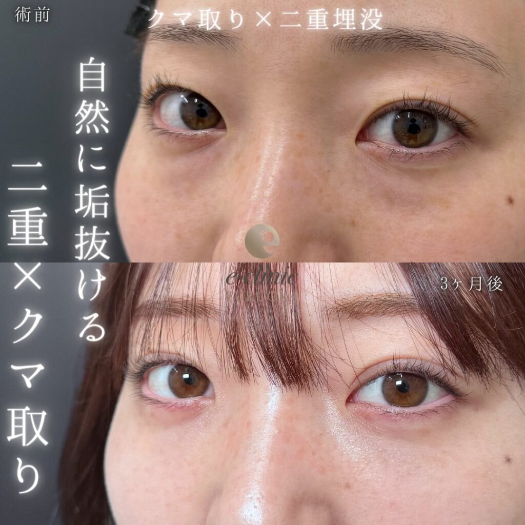 埋没法と裏ハムラ法の用例写真 (3)