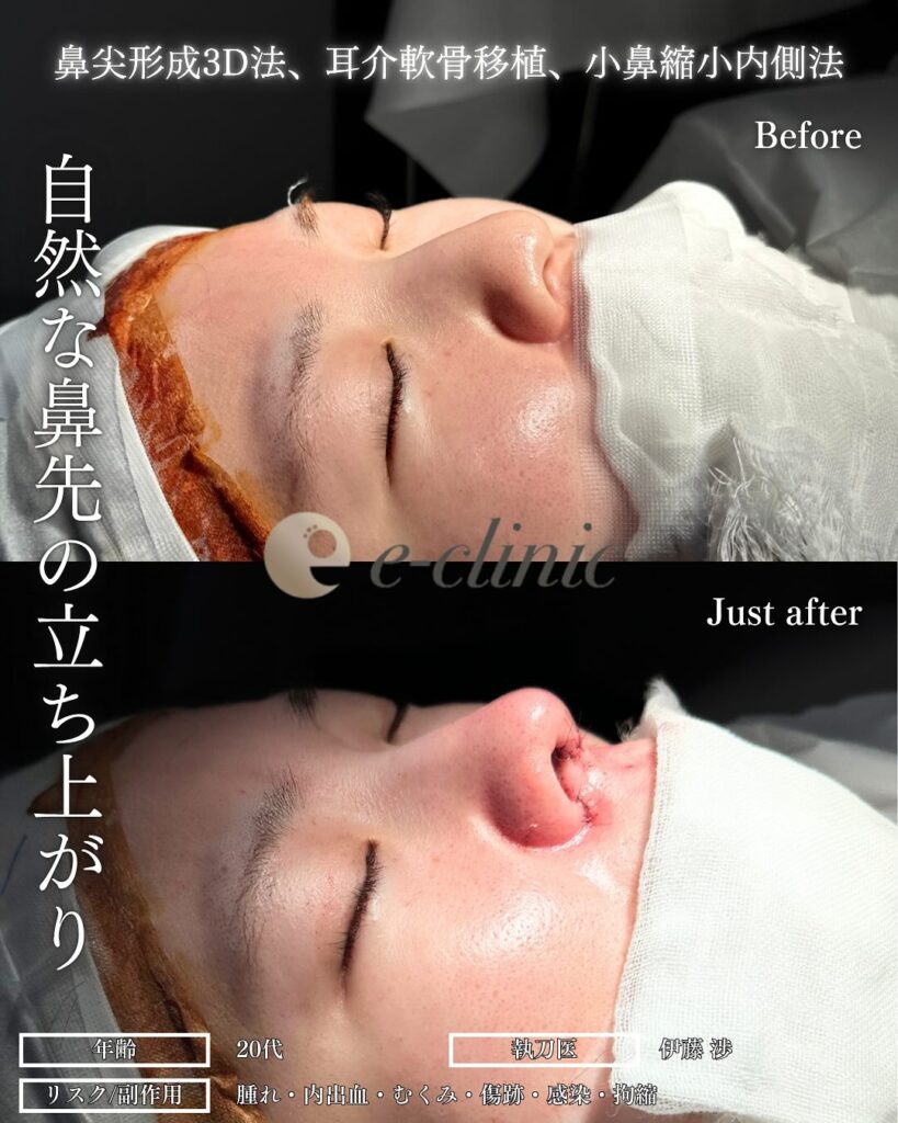 鼻尖形成と耳介軟骨移植と小鼻縮小の症例写真 (3)