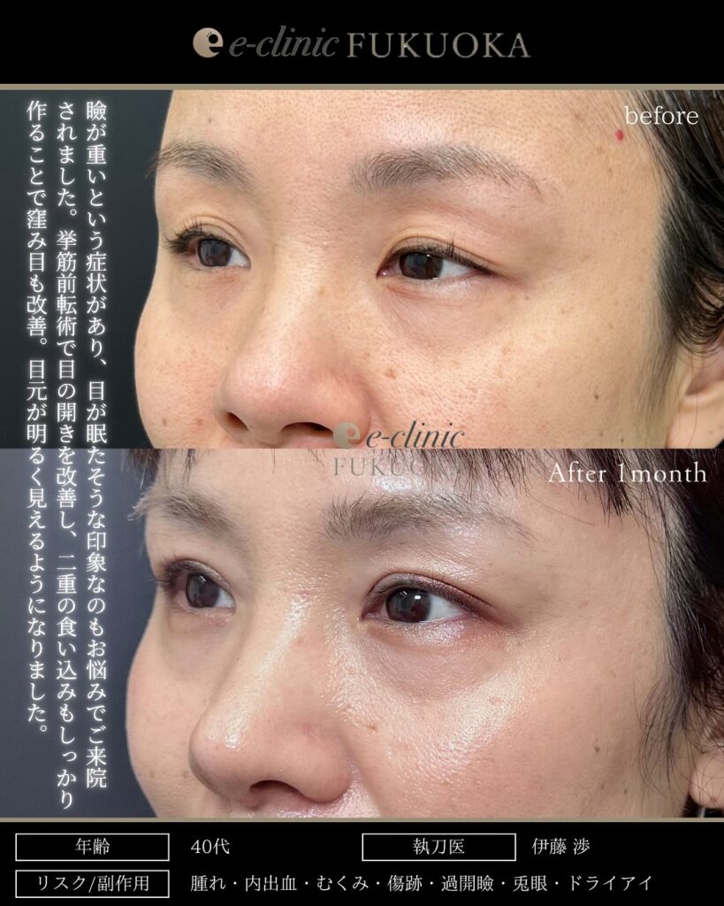 全切開と眼瞼下垂症例写真 (3)