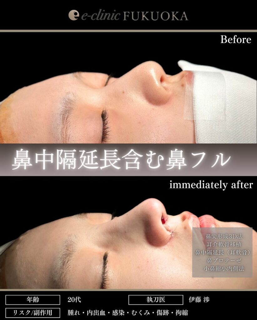 鼻中隔延長と鼻尖形成と耳介軟骨移植と小鼻縮小とプロテーゼの症例写真 (1)