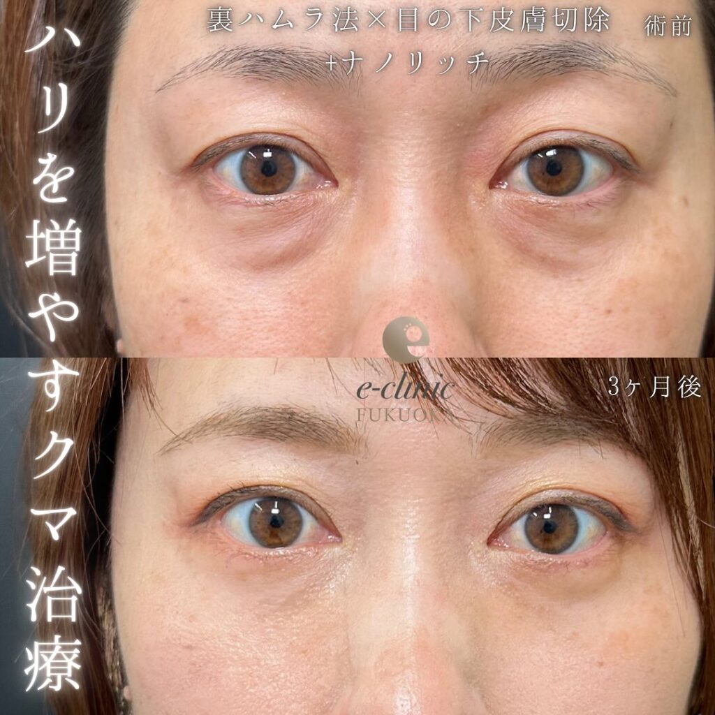 目の下のたるみ取りと裏ハムラ法と脂肪注入の症例写真 (1)