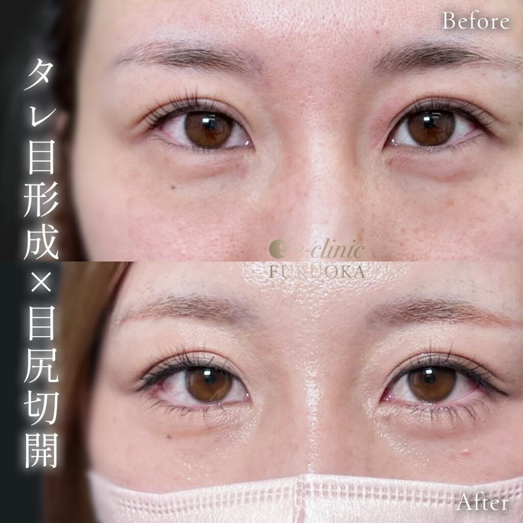 タレ目形成+目尻切開の症例写真 (1)