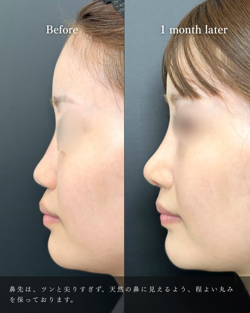 鼻中隔延長と鼻尖形成と軟骨移植とプロテーゼの症例写真 (6)