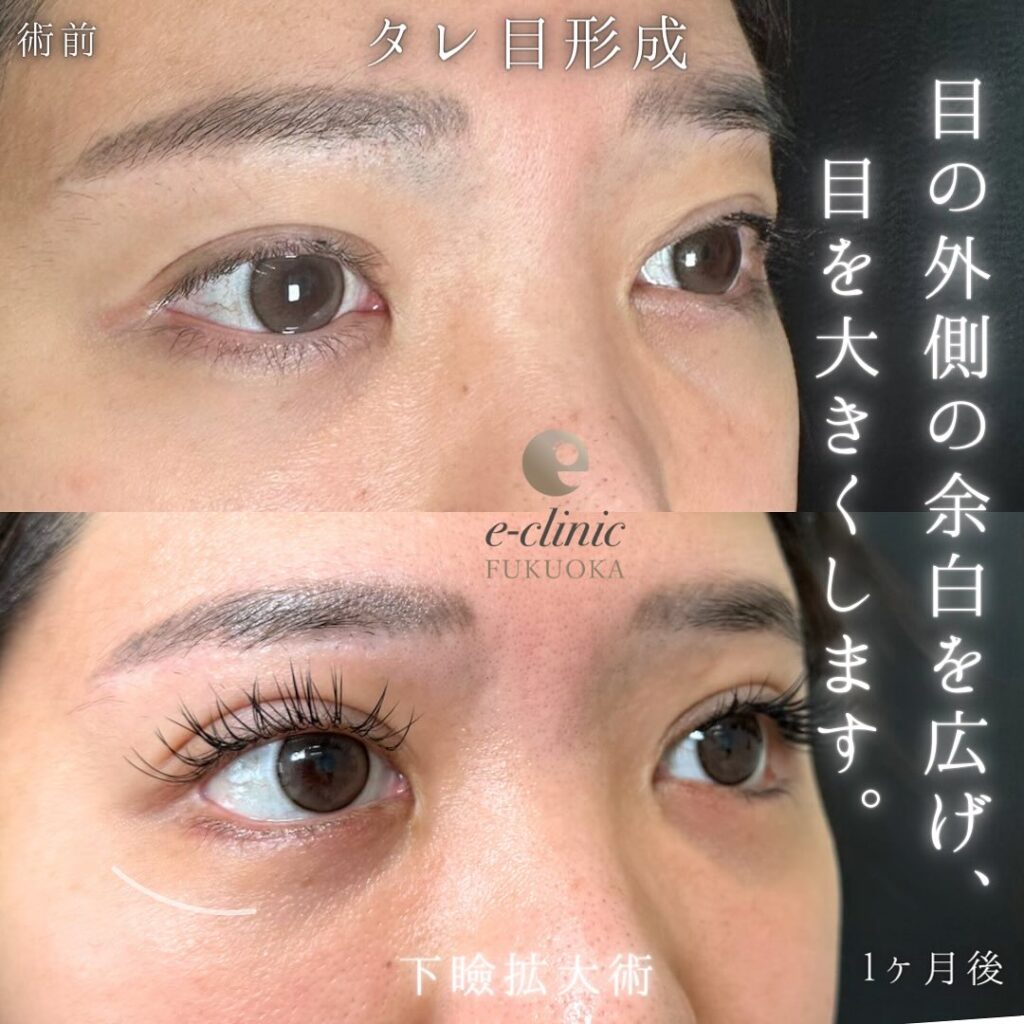 タレ目形成の症例写真 (8)