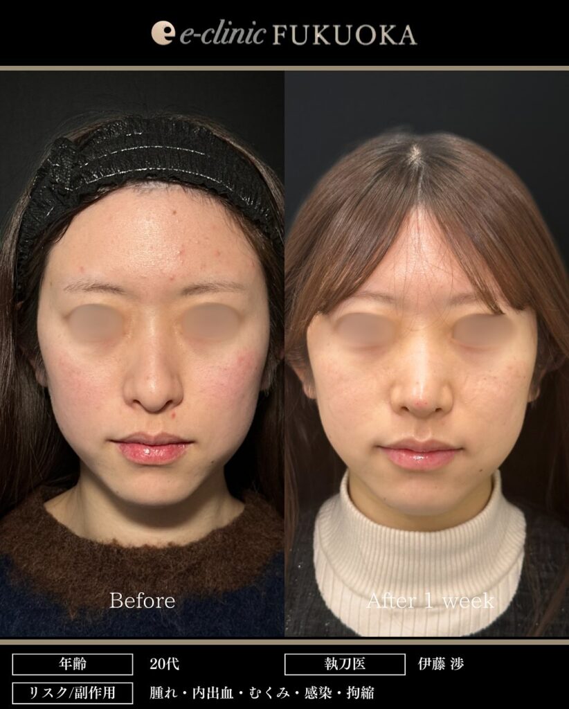 鼻尖形成と軟骨移植の症例写真 (18)