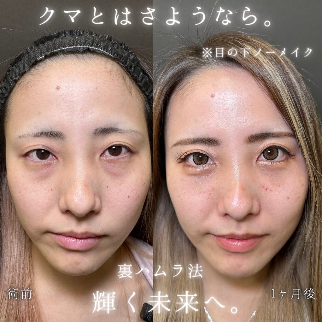 裏ハムラ法の症例写真 (30)