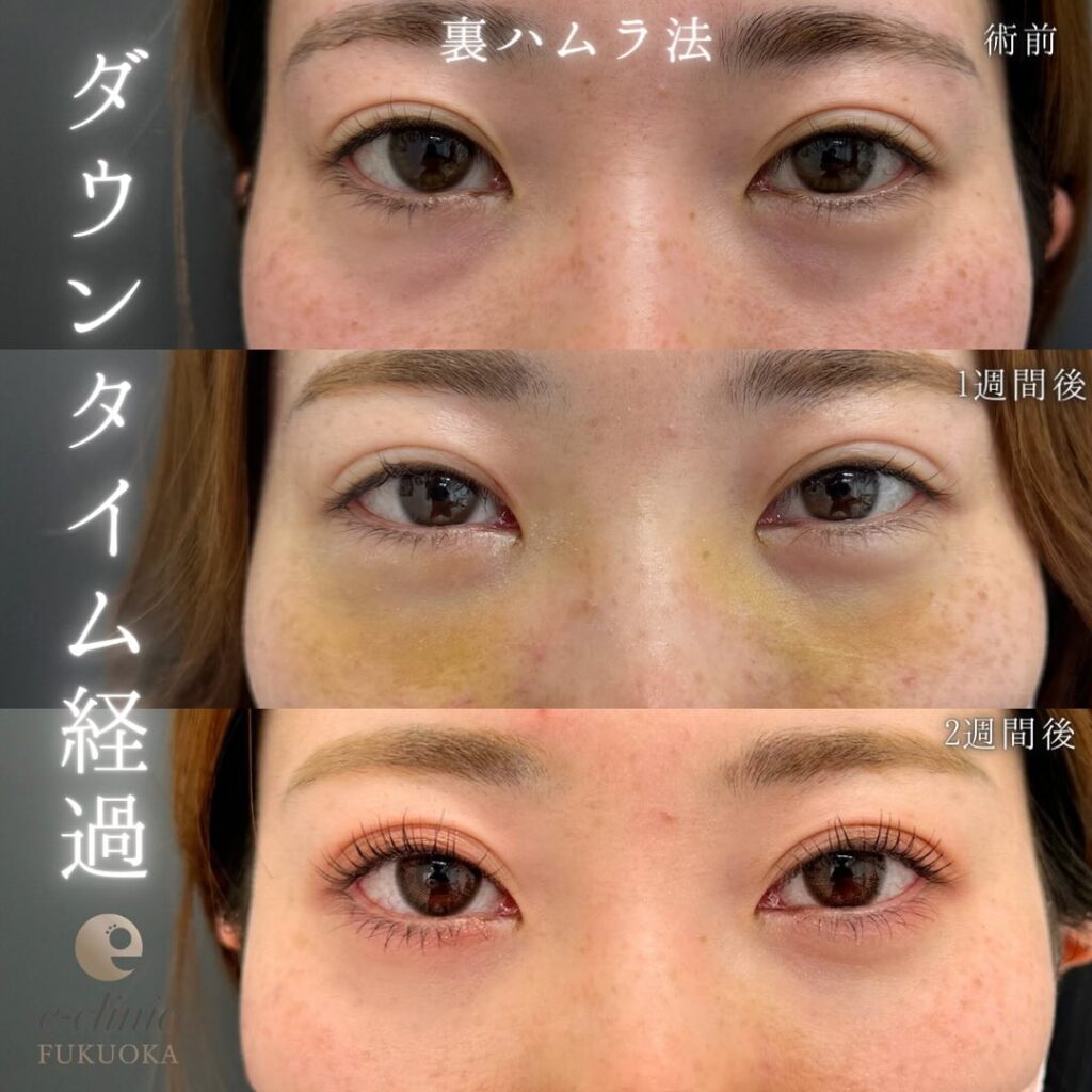 裏ハムラ法の症例写真 (61)