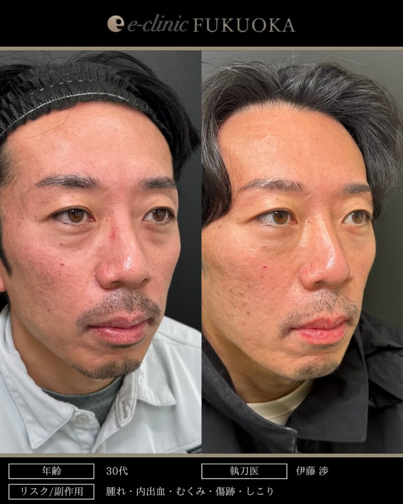 裏ハムラ法と脂肪注入の症例写真 (36)