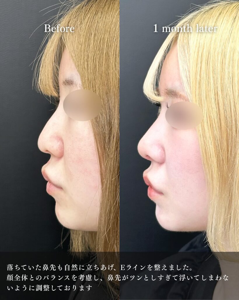 小鼻縮小と小鼻ボトックスと鼻尖形成と鼻中隔延長と軟骨移植の症例写真 (3)