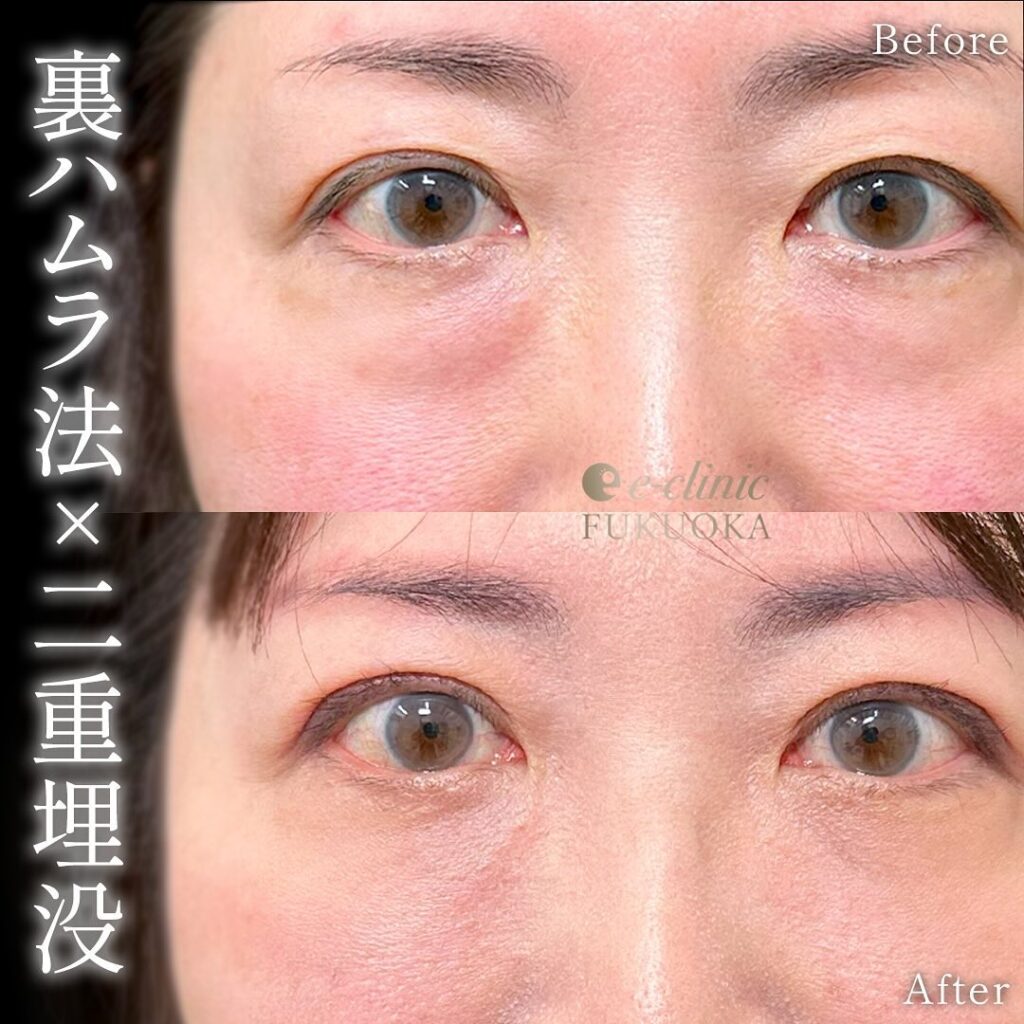 裏ハムラ法と埋没法の症例写真 (7)