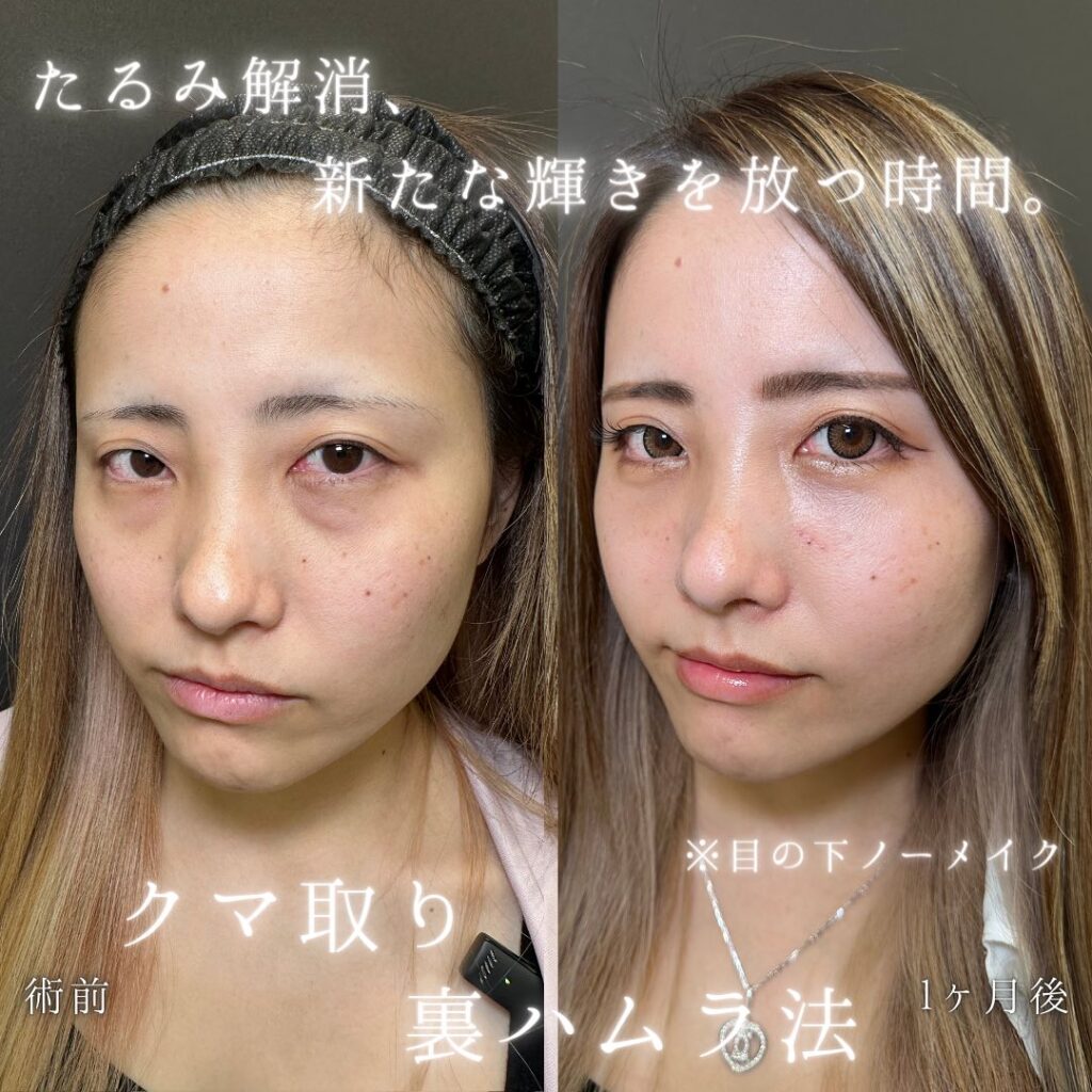 裏ハムラ法の症例写真 (34)