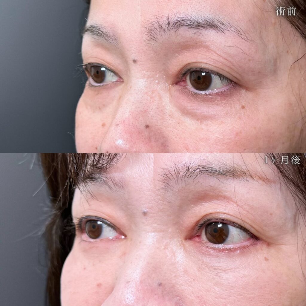 裏ハムラ法の症例写真 (68)