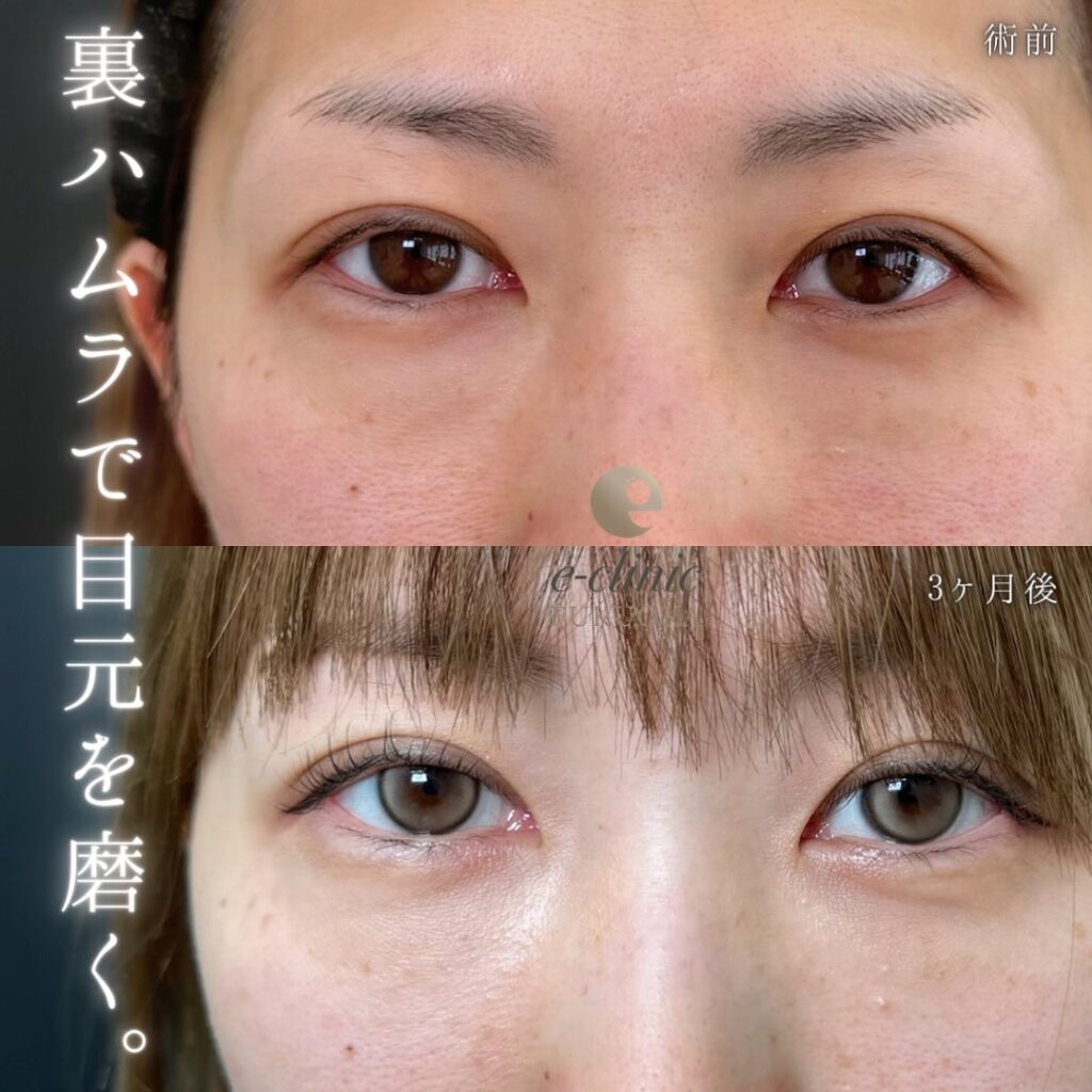 裏ハムラ法の症例写真 (62)