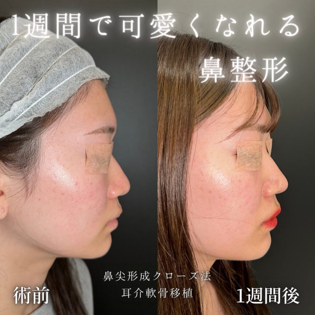 鼻尖形成と軟骨移植の症例写真 (2)