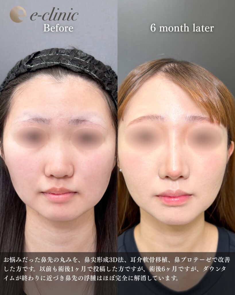 鼻尖形成と耳介軟骨移植とプロテーゼの症例写真 (11)