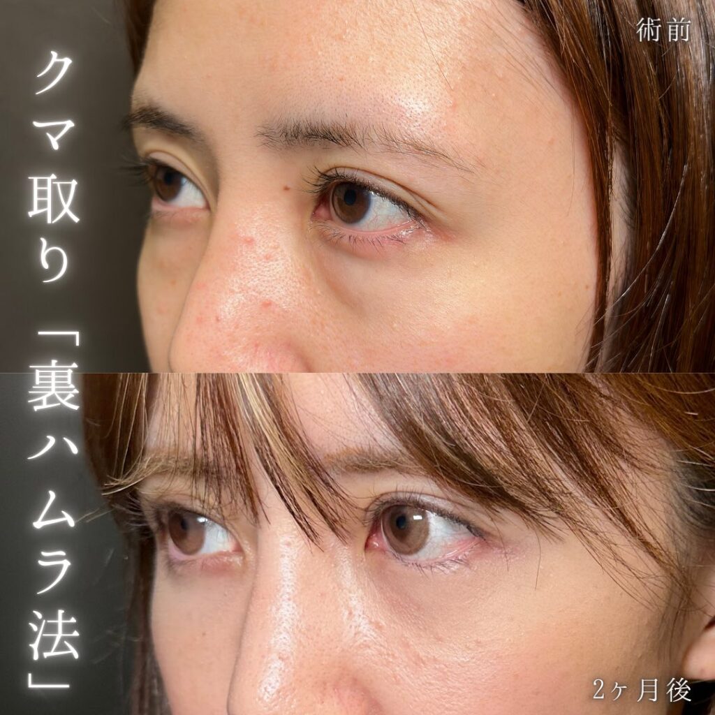 裏ハムラ法の症例写真 (28)