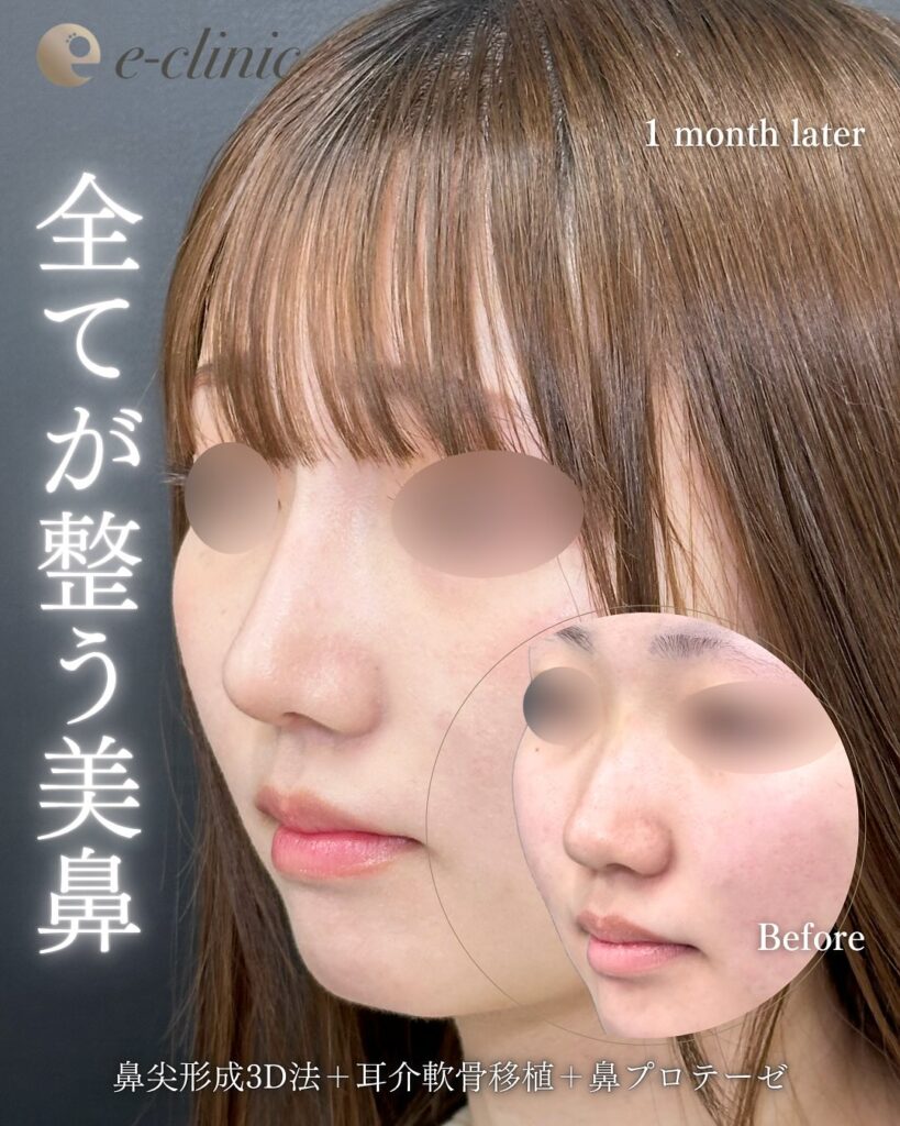 鼻尖形成と軟骨移植とプロテーゼの症例写真 (8)