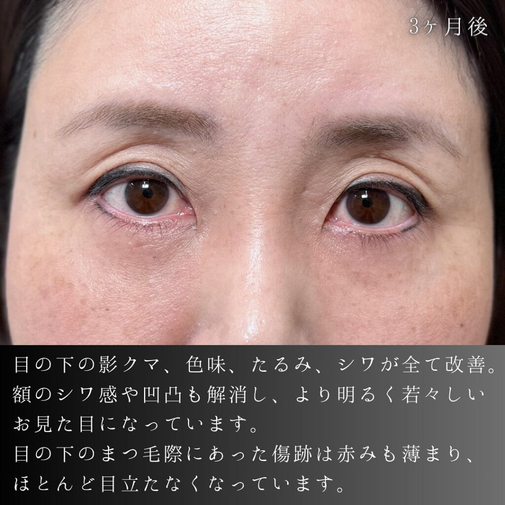 裏ハムラ法と目の下の脂肪注入と額とこめかみの脂肪注入の症例写真 (4)