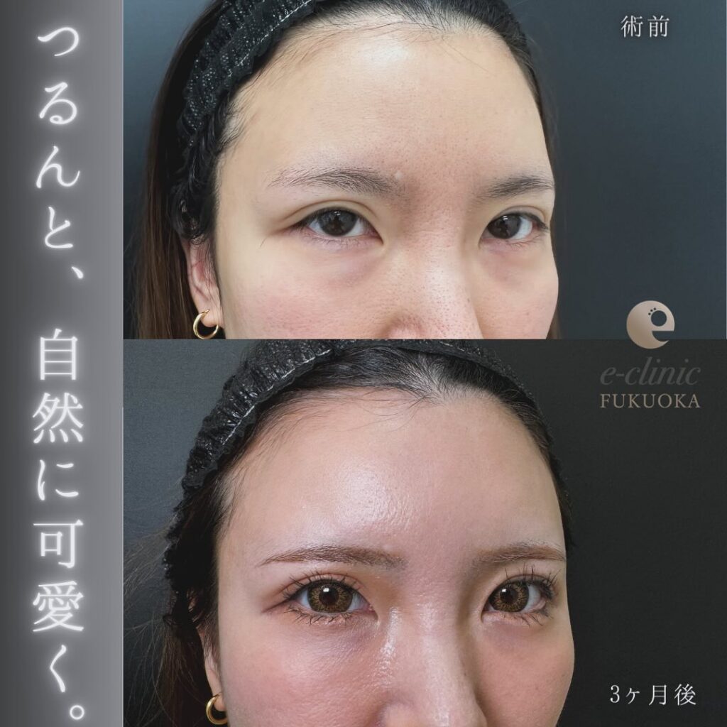 裏ハムラ方と脂肪注入の症例写真 (3)