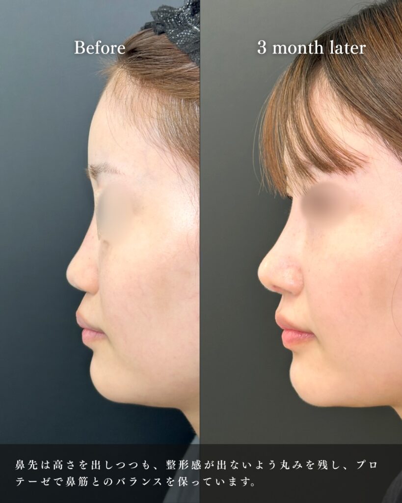 鼻中隔延長と鼻尖形成と軟骨移植とプロテーゼの症例写真 (11)